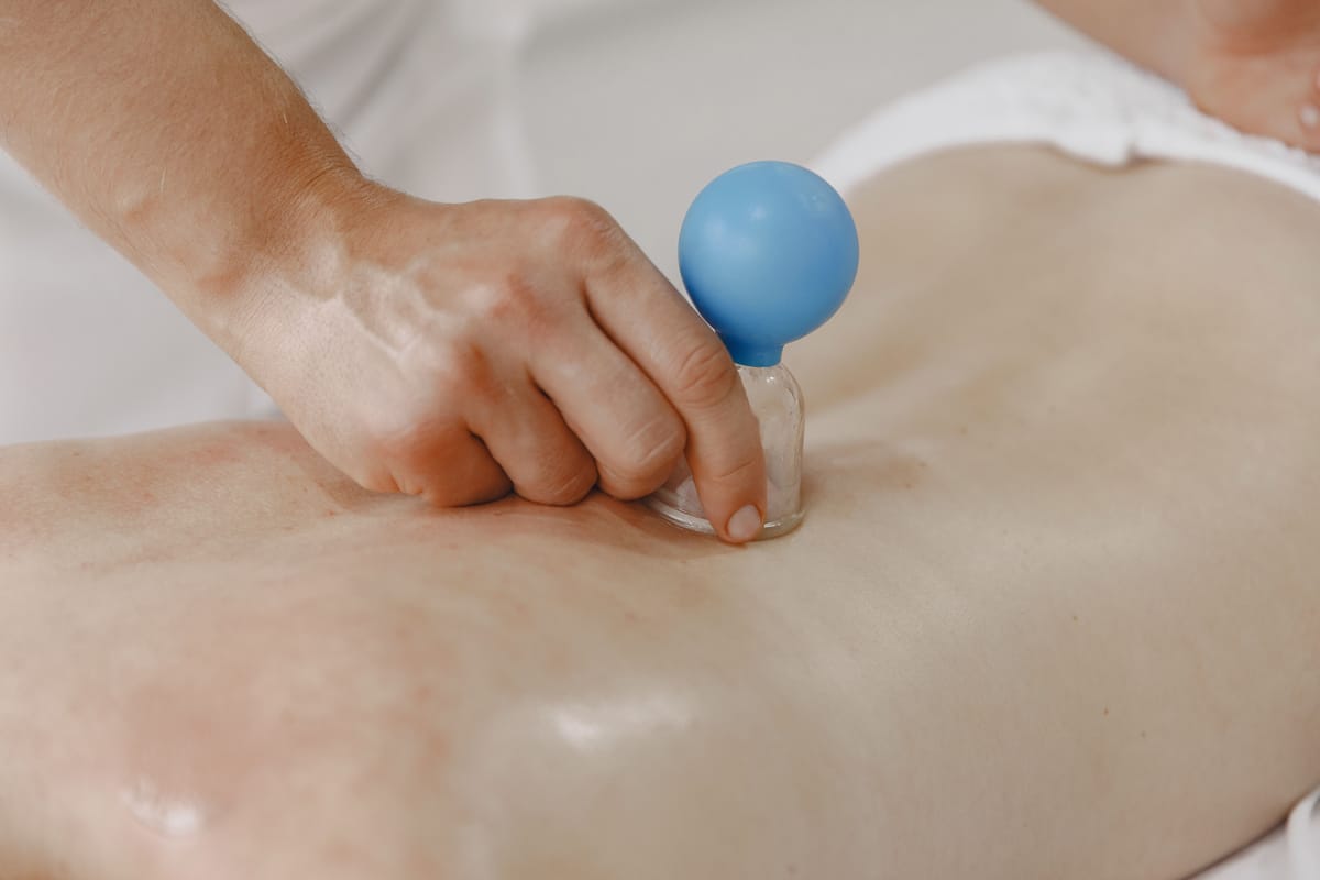 Physiotherapist applying transparent suction cups to a patient's back during cupping therapy
